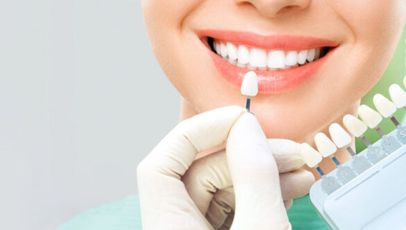 لمینت دندان چیست و برای چه کسانی مناسب است؟