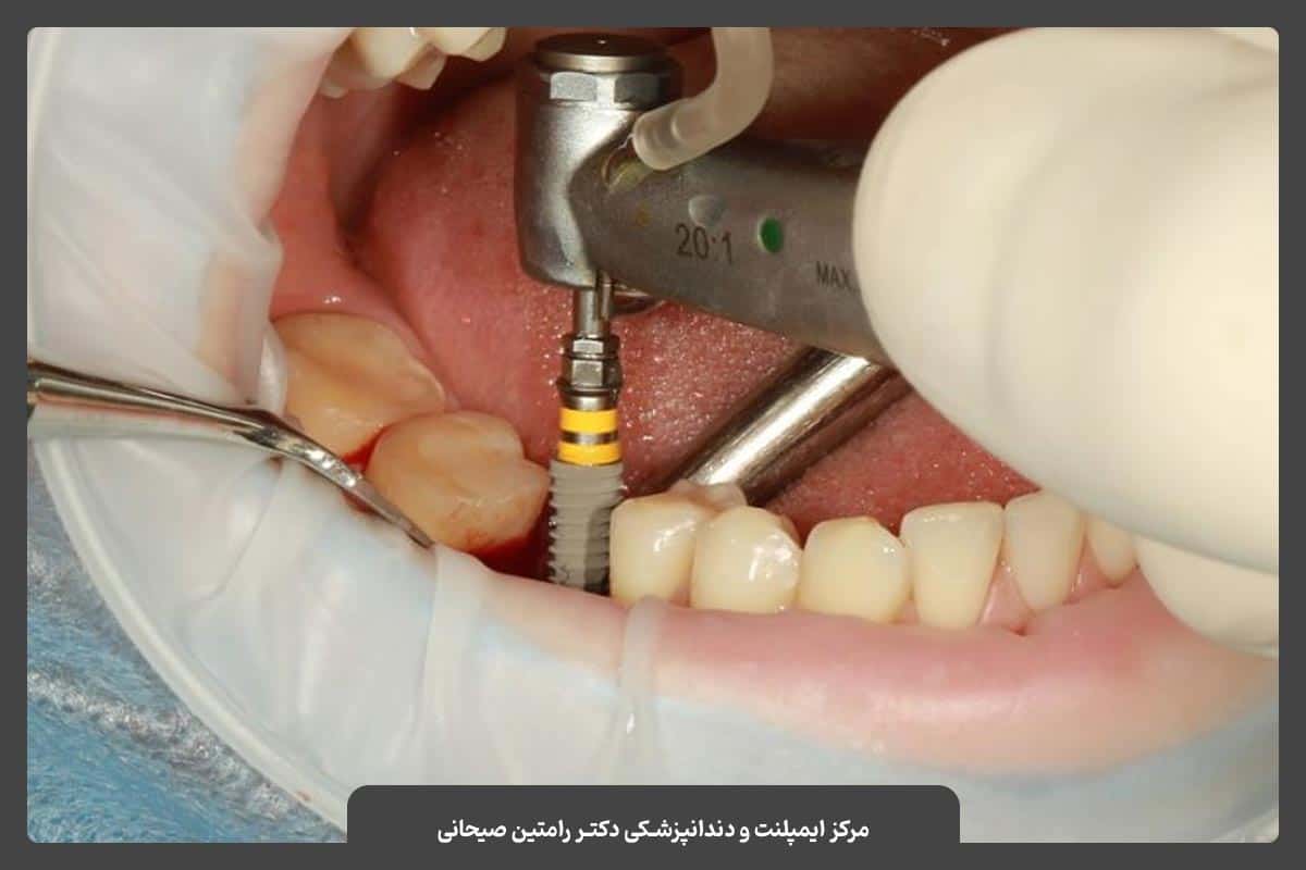 عمل جراحی ایمپلنت یا کاشت دندان