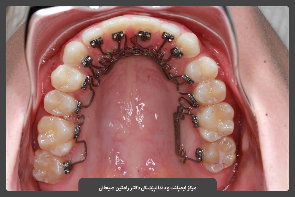 ارتودنسی لینگوال یا پشت دندانی