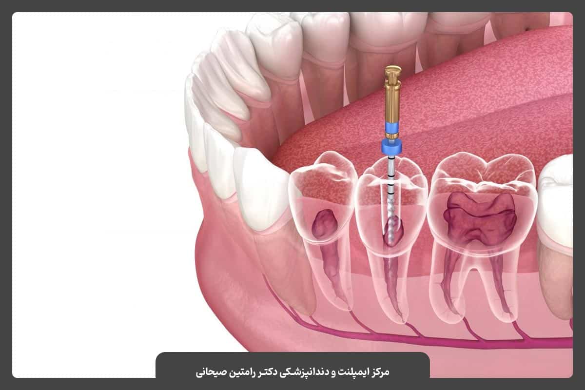 نحوه درمان کانال ریشه یا عصب‌کشی