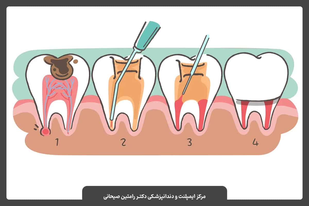 مراحل درمان کانال ریشه یا عصب‌کشی
