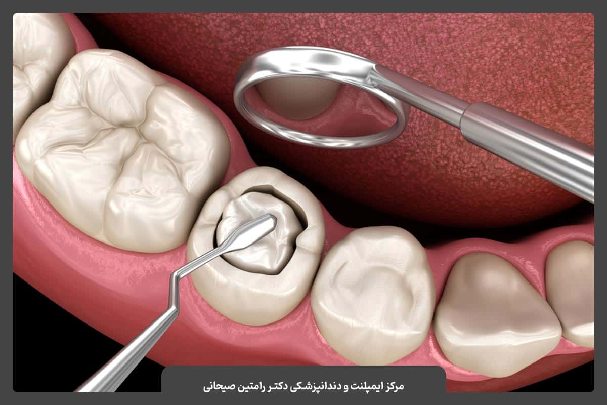 ترمیم یا پر کردن دندان‌های پوسیده
