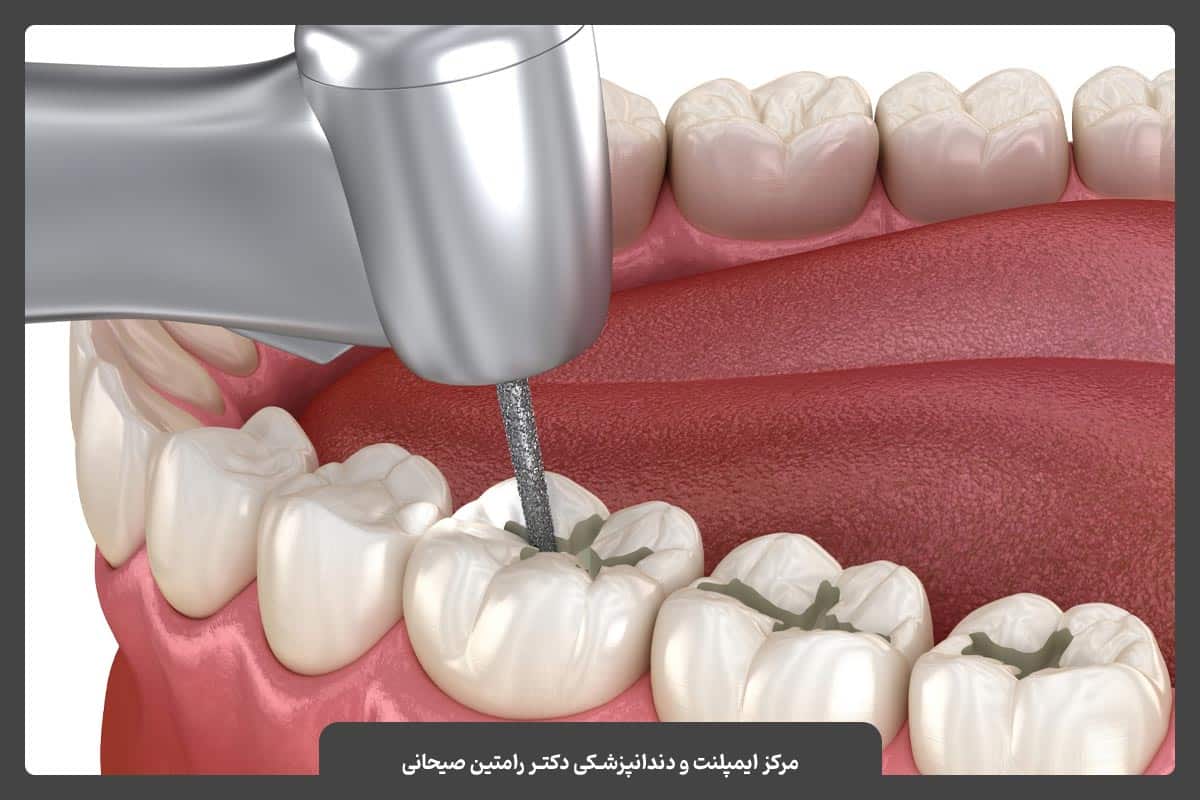 ترمیم یا پر کردن دندان