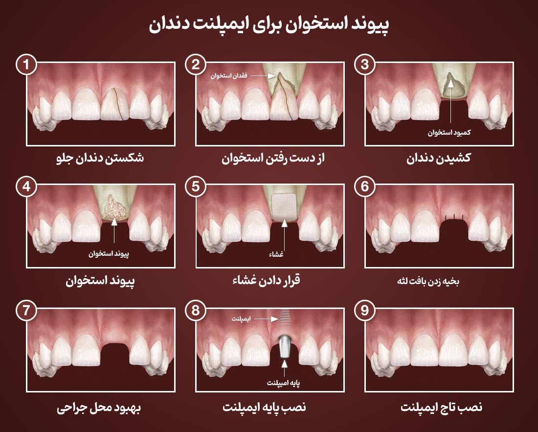 مراحل پیوند استخوان در ایمپلنت دندان