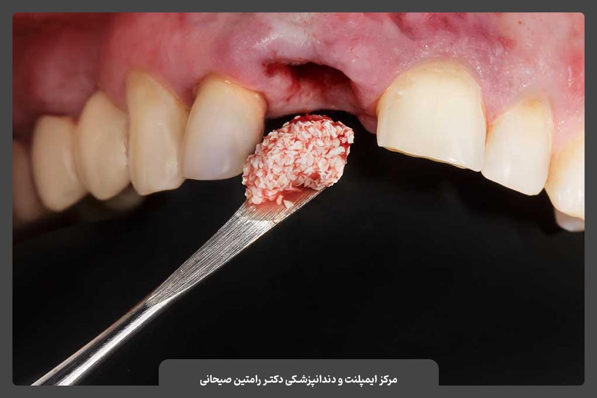 عمل پیوند استخوان برای ایمپلنت