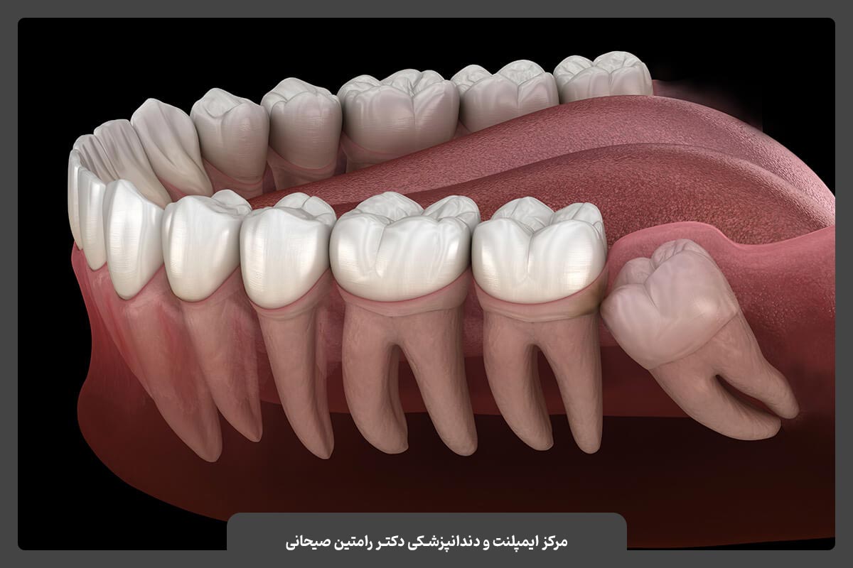 جراحی دندان عقل نهفته