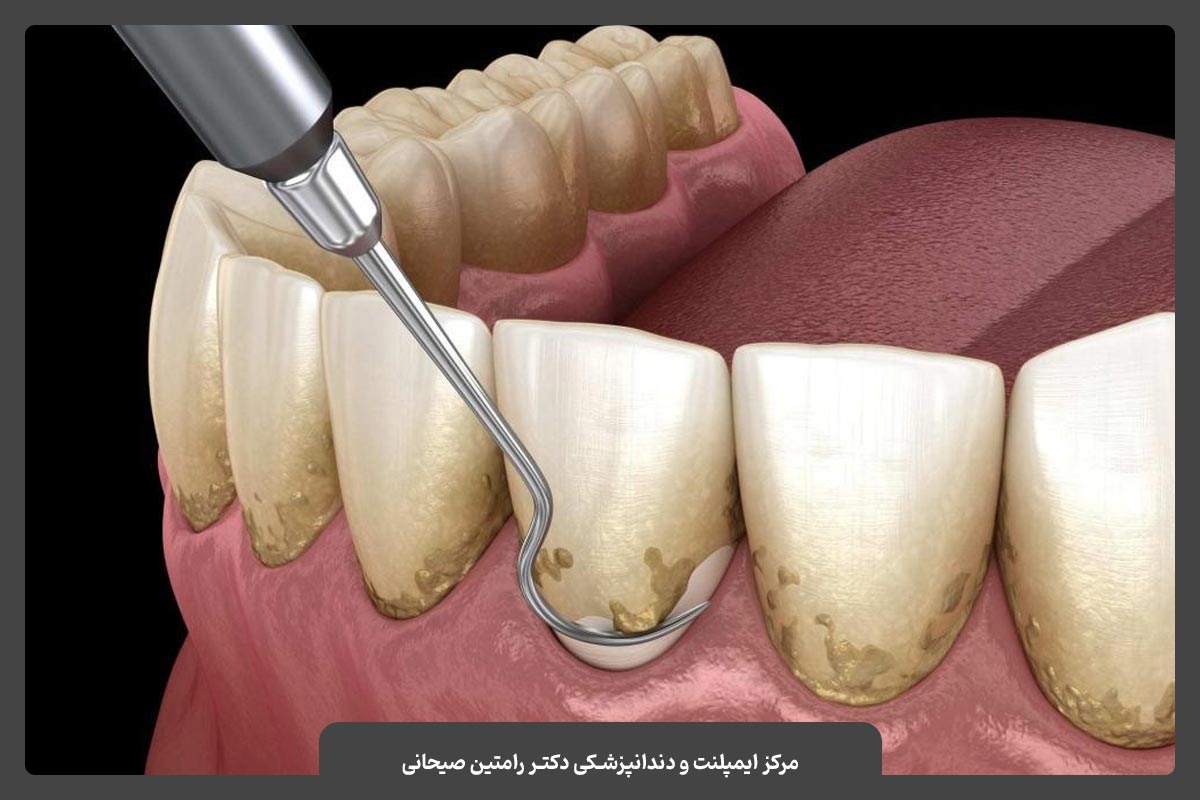 انواع متدها جرم‌گیری دندان‌ها