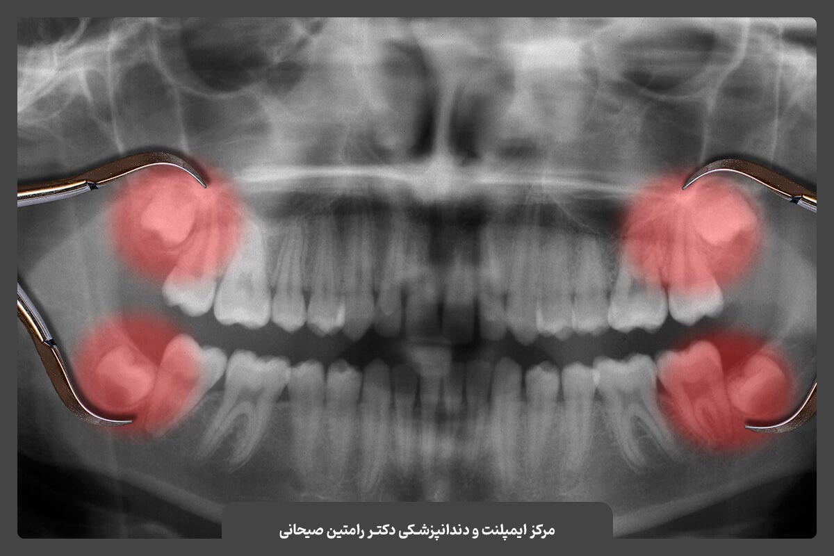 مشکلات ناشی از دندان عقل